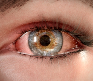 3D model of eye with dry eye disease designed by Random42
