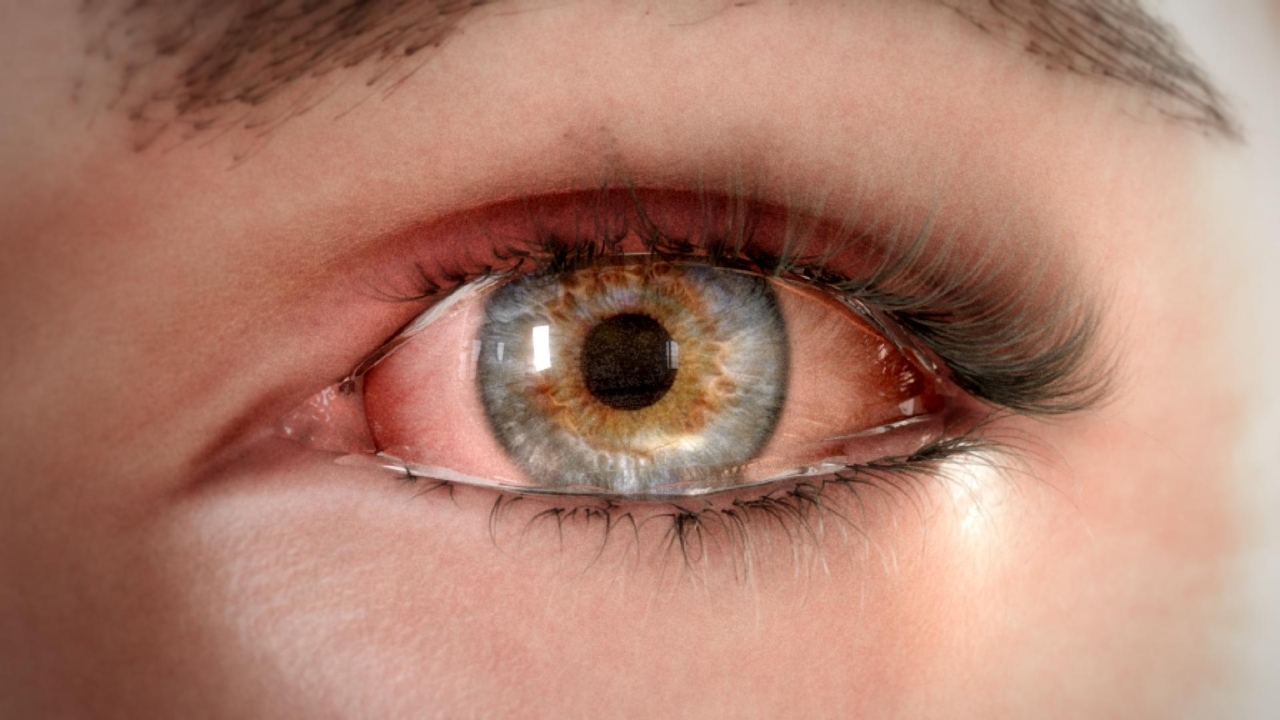 Random42 Dry Eye Disease VR