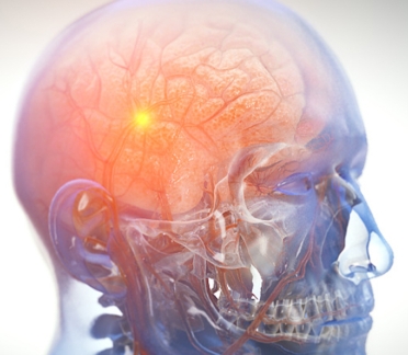 Traumatic Brain Injury Animation