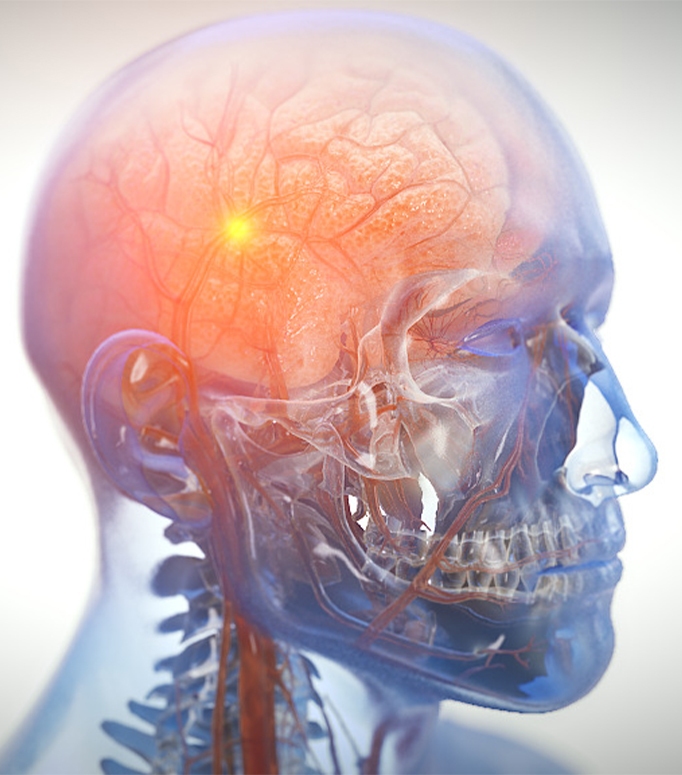 Traumatic Brain Injury Animation