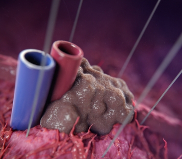 Irreversible Electrophoration Scientific Animation