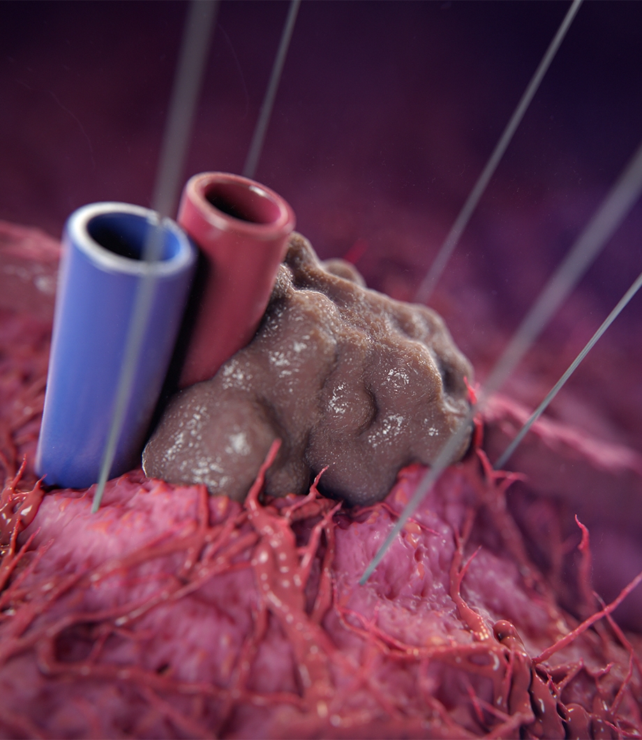Irreversible Electrophoration Scientific Animation