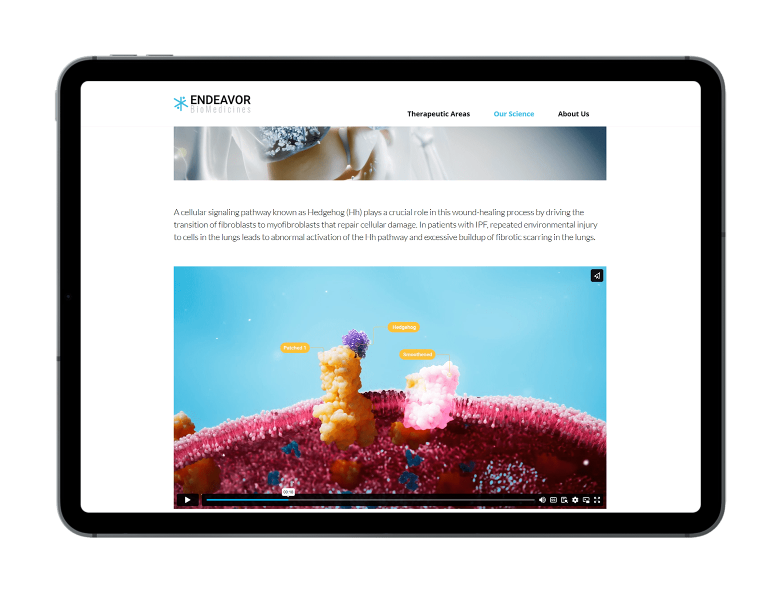 idiopathic fibrosis medical animation