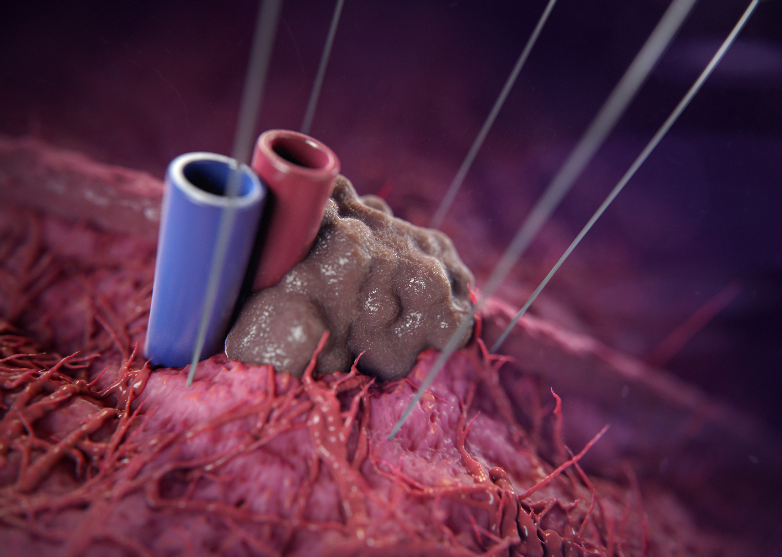 Irreversible Electrophoration Scientific Animation