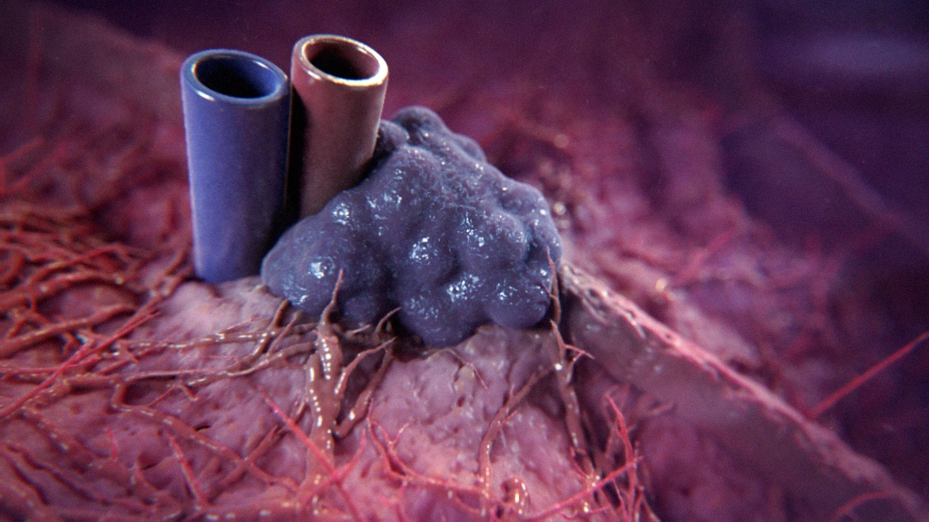 IRE Therapy Medical Animation